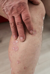 Fototapeta premium man hand scratching allergy rash