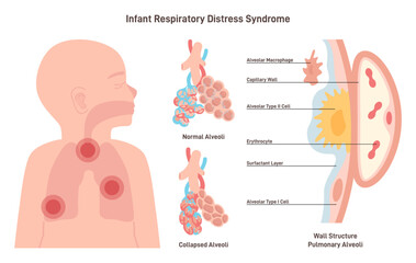 Infant respiratory distress syndrome. Congenital pathology of baby's - obrazy, fototapety, plakaty