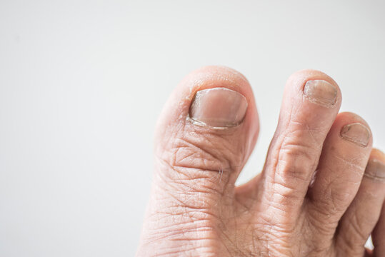 Older person's toe with dry skin problem and have nail fungus