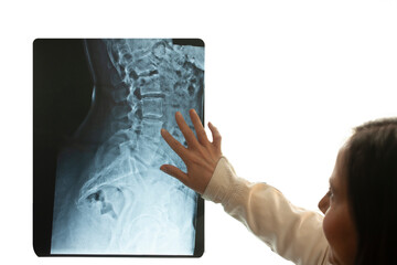Doctor pointing out scoliosis of the spine on patient's x-ray showing human anatomy of bones in...