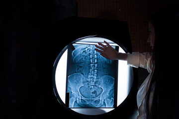 Doctor works analysis and diagnosis of the spine of a patient presenting congenital scoliosis in bone anatomy front view