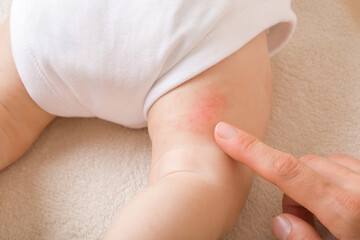 Young adult mother finger pointing to newborn leg with red rash. Allergy from milk formula or...