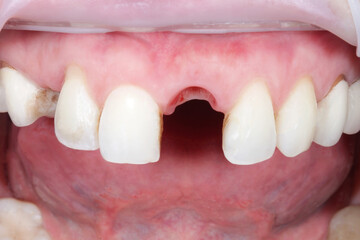 Man showing mouth without broken tooth. Close up macro photo