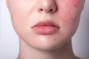 rosacea couperose redness skin, red spots on cheeks, young woman with sensitive skin, patient face...