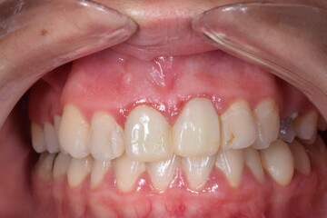 Fixed prosthetic crowns in central incisors. Frontal view of maxillary arch incisor and canine teeth, gum inflammatory. Cheeks and lips retracted with transparent cheek retractor.