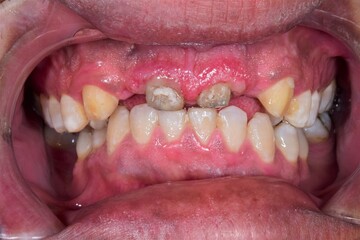 Front view of decayed broken incisors, dental roots and inflammatory red bleeding gingival gum with...