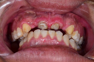 Front view of decayed broken incisors, dental roots and inflammatory red bleeding gingival gum with...