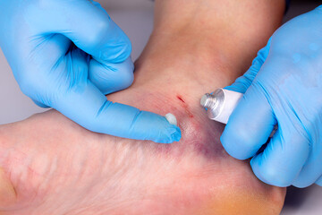 Doctors hands in gloves smear medicinal ointment to bruise on the patients leg