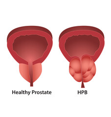 Prostate - Próstata