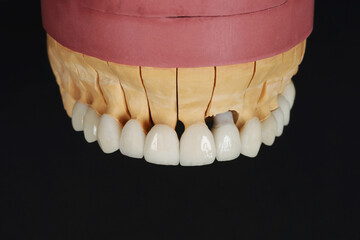Denture. Full removable denture of the upper jaw of man with white beautiful teeth in the hand of a dentist. Aesthetic Dentistry