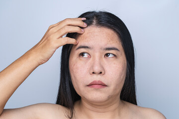 Asian adult woman face has freckles, large pores, blackhead pimple and scars problem from not take...