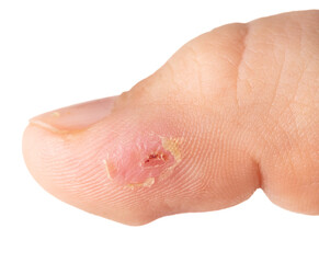 Wound on a man's finger. Macro