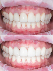 Smiling man before and after teeth whitening procedure, closeup. Collage