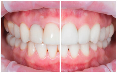 Smiling man before and after teeth whitening procedure, closeup. Collage