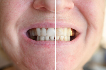 Before and after teeth whitening procedure.