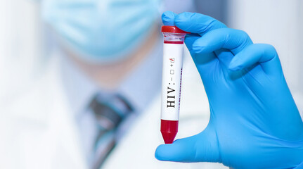 Doctor's hand holds test tube in blood.Blood sample positive with HIV testing.