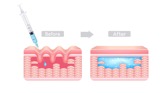 Injection filler and botox injection under the skin on face with wrinkle dermal layer before and after. Facial hyaluronic acid (HA-Filler). Medical and beauty concept. File PNG 3D.