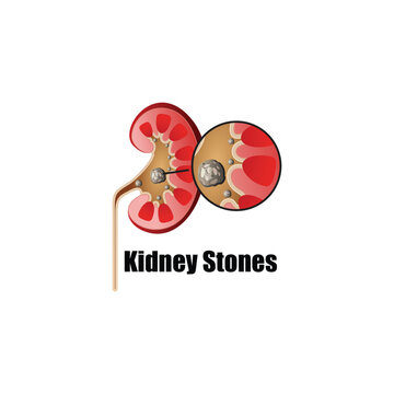 Human Kidney Stones, Kidney Inside, Kidney System, Bean shape, Vector illustration.