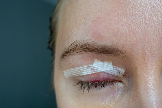 close up woman eyes after plastic surgery, yellow red color skin bruising, blepharoplasty operation, swollen bruised eyelids, incisions stitches covered with medical tape, wound closure strips