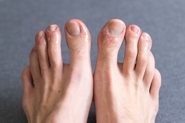 covid toes, bites on a man's toes.
