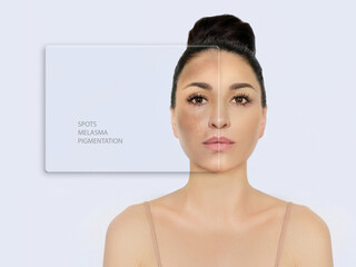 Dark spots, freckles,hyperpigmentation(melasma or chloasma),concept - skin lightening, skin whitening, fruit acids,AHA, Skin Brightening