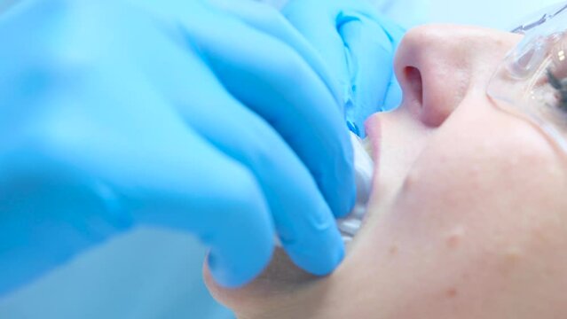 dental instrument, retractor, Classification of oral dilators and retractors for dentistry woman opens mouth dentist hands set white transparent rubber dam for dental procedures dental treatment face