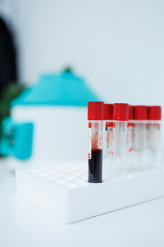 Blood is collected in a medical tube for analysis. Blood for medical research