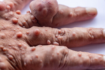 Background of human skin with Neurofibromatosis are a group of genetic disorders that cause tumors...