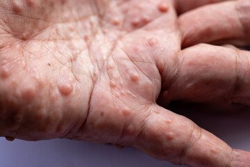 Background of human skin with Neurofibromatosis are a group of genetic disorders that cause tumors...