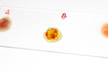 Human blood cells, Blood group and white blood cell study under microscopic.
