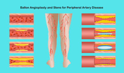 Diagram showing angioplasty for peripheral artery disease illustration. Concept of dry skin, old senior people, varicose veins and DVT .