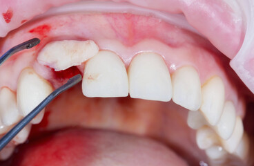 Soft tissue augmentation procedures. Gum grafting from the palate into the area of the removed...