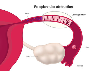 Fallopian tube obstruction. Block fallopian tube. Uterus and uterine tubes. Female reproductive system. Sperm cannot pass through and mix with the egg. Considered one of the causes of infertility.