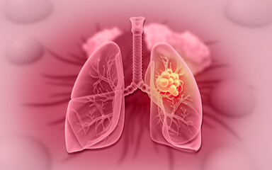 Lungs cancer concept. 3d illustration..