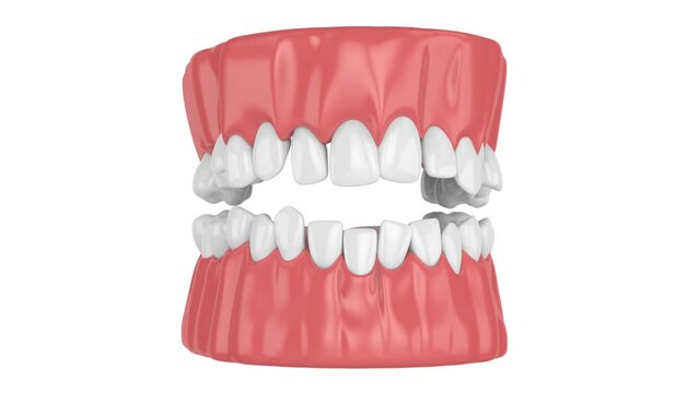 Human jaw with crooked teeth straightening. Orthodontic treatment concept. 