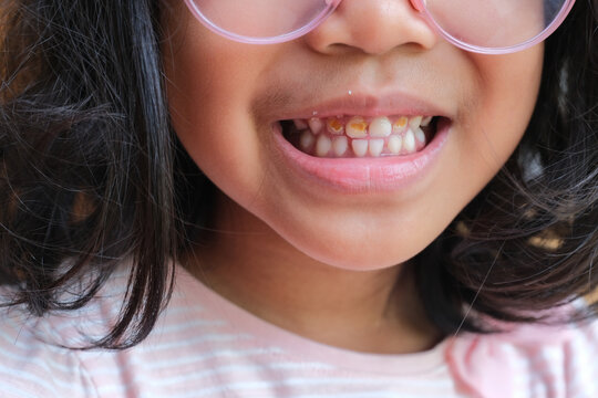 Closeup shot of a little girl's decaying teeth