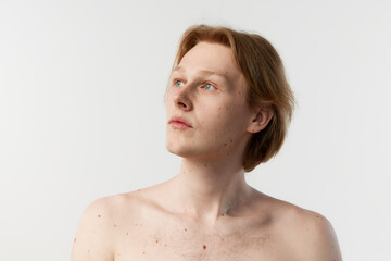 Naklejka premium Body covered with moles. Portrait of young redhead man posing shirtless over grey studio background. Looking away. Concept of men's health, body and skin care, hygiene and male cosmetology
