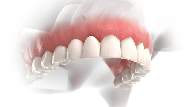 Process of installing veneers on a worn lateral incisor
