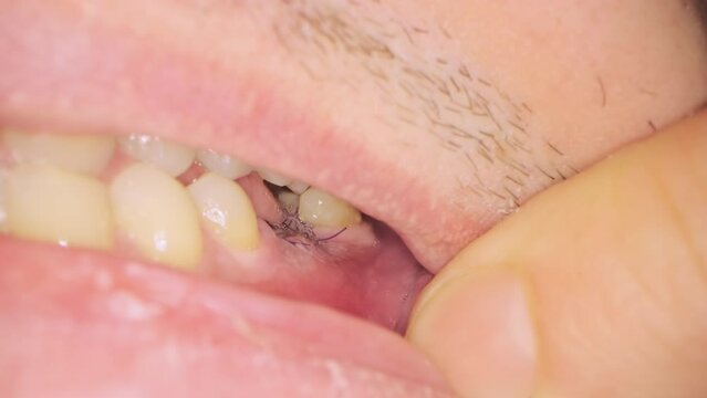 Male patient shows black threads on gum after implantation opening mouth with finger. Teeth treatment in dental clinic extreme closeup
