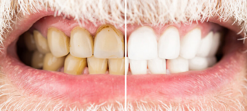 Male teeth before and after whitening, oral care dentistry, stomatology. Smiling man before and after teeth whitening procedure, closeup