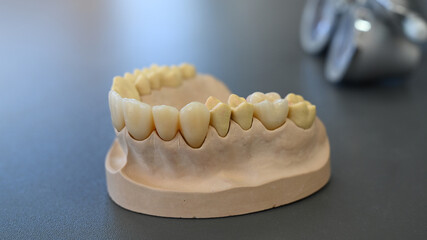Tooth denture with abutments layered with ceramic by dental technician.