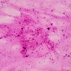 Fototapeta premium Ascetic fluid cytology, Malignant cells, Metastatic adenocarcinoma, microscopically show atypical epithelial cells, small clusters, background show inflammatory cells and fluidly material.