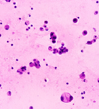 Ascetic fluid cytology, Malignant cells, Metastatic adenocarcinoma, microscopically show atypical epithelial cells, small clusters, background show inflammatory cells and fluidly material.