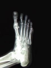 X-Ray of a healthy female human right foot from above