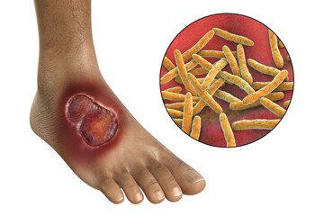 Buruli ulcer on a patient foot, 3D illustration. The disease caused by Mycobacterium ulcerans bacteria - obrazy, fototapety, plakaty
