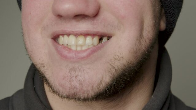 Big smile of a bearded man. Crooked teeth and broken teeth. Teeth that require dental and orthodontic treatment. Teeth that need to be professionally cleaned and treated for caries