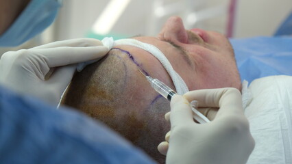 hair transplant surgery. during hair transplant doctor and patient