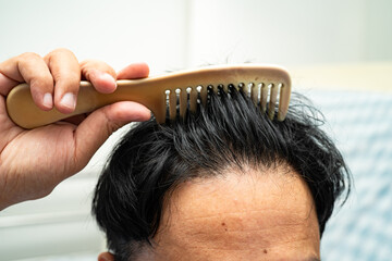 Fototapeta premium Bald at front of head and begin no loss hair glabrous of mature Asian business smart active office man.