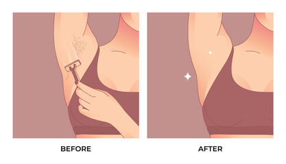 Armpit Hair before and after laser waxing.