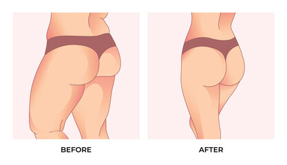 Thigh fat. Before and after weight loss, woman body shape transformation, Fat To Fit. - obrazy, fototapety, plakaty